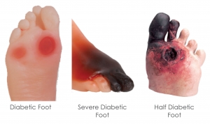 DIABETIC FOOT MODELS